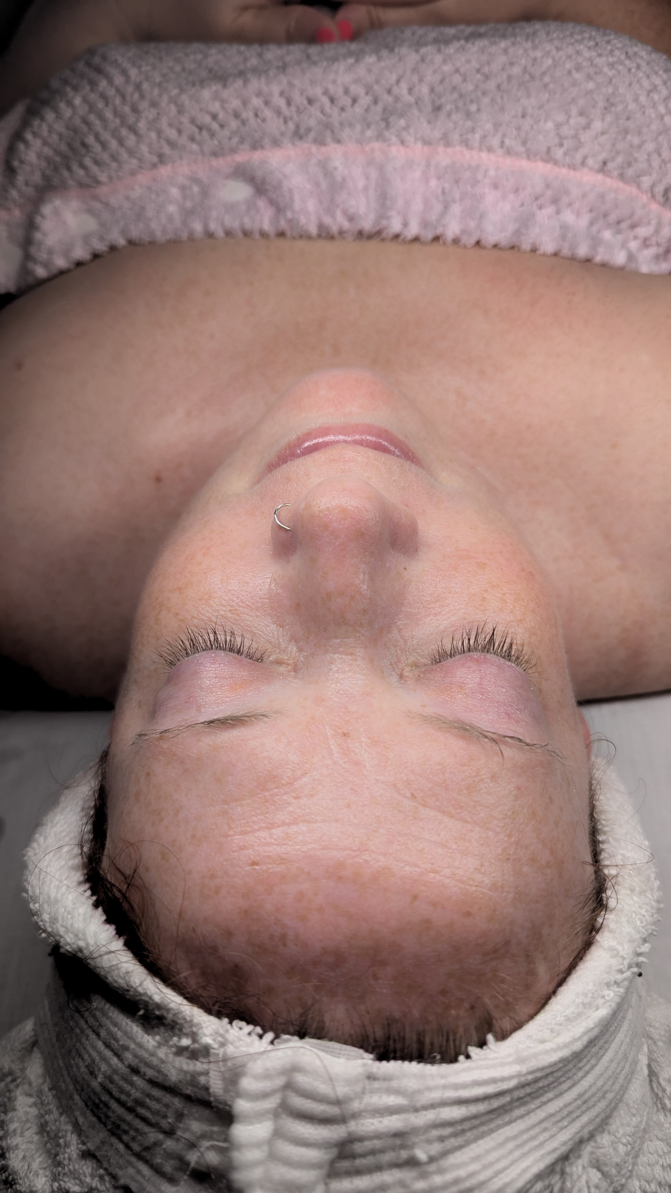 Before facial